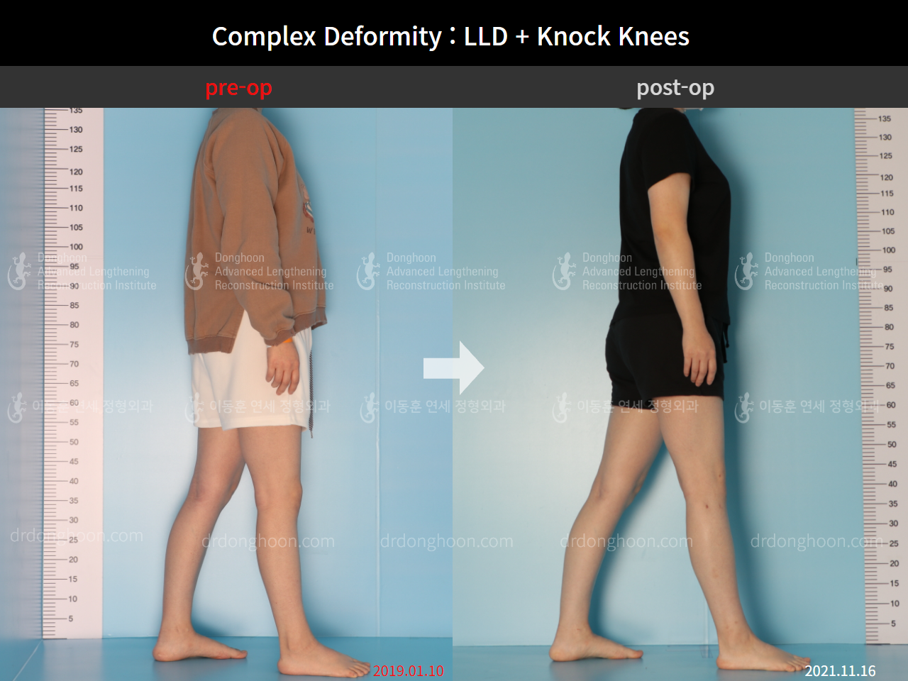 Before and after adult lld, case 9041582, image 8, Dr. Donghoon institute (DALRI)