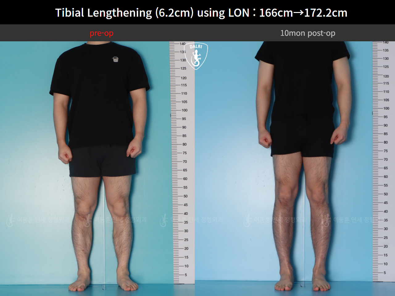 Before and after cll lon, case 128591201, image 2, Dr. Donghoon institute (DALRI)