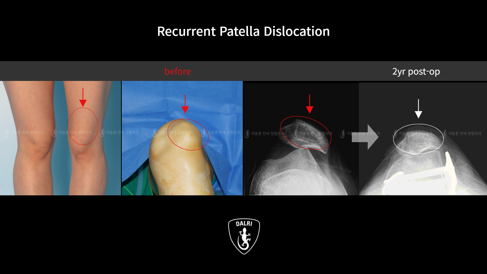 Before and after recurrent patella dislocation, case 10329296, image 2, Dr. Donghoon institute (DALRI)