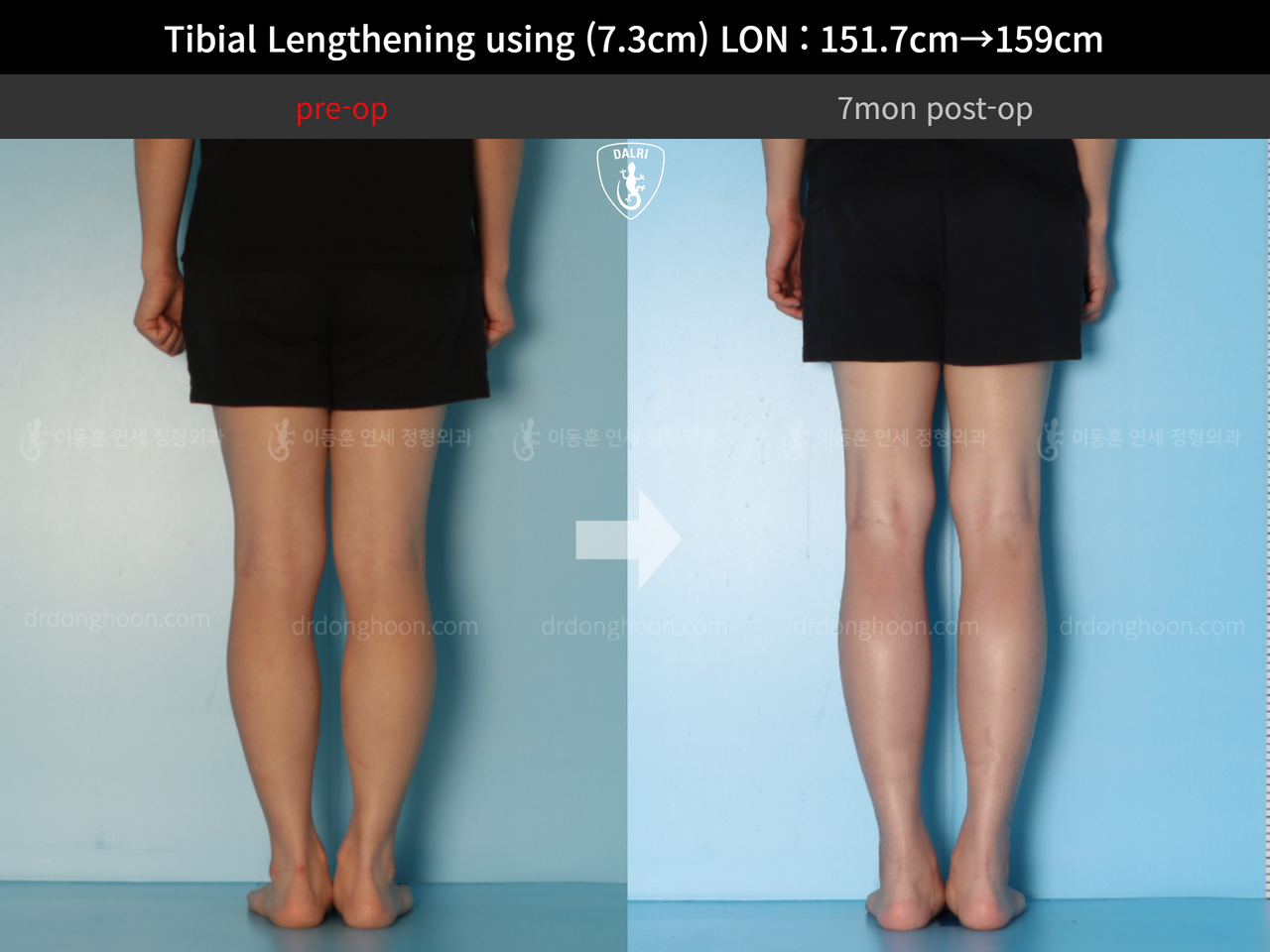 Before and after cll lon, case 13119336, image 6, Dr. Donghoon institute (DALRI)