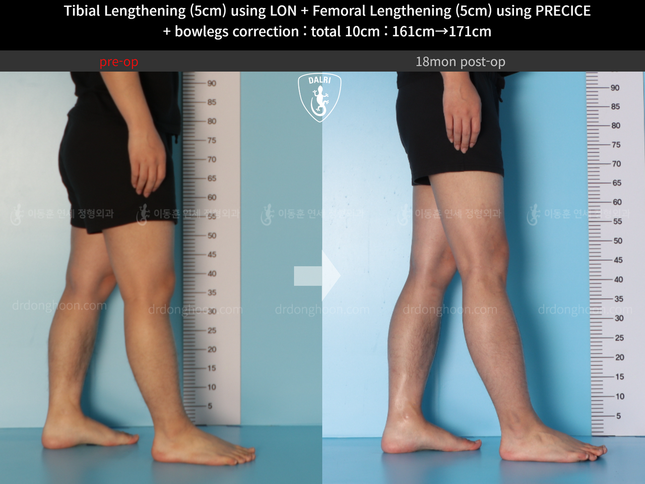 Before and after cll precice, case 13660867, image 10, Dr. Donghoon institute (DALRI)