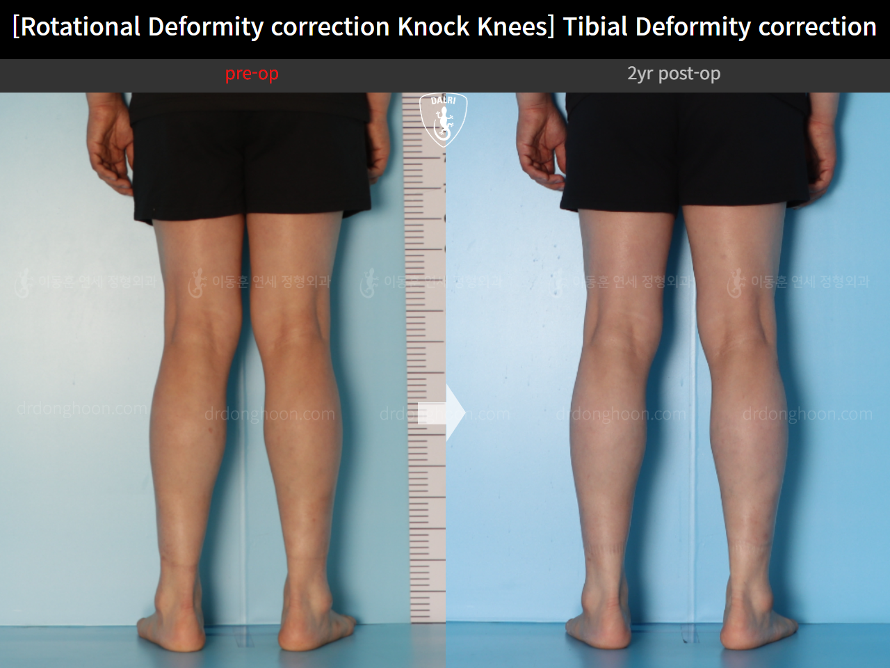 Before and after adult knock knees, case 15524370, image 8, Dr. Donghoon institute (DALRI)