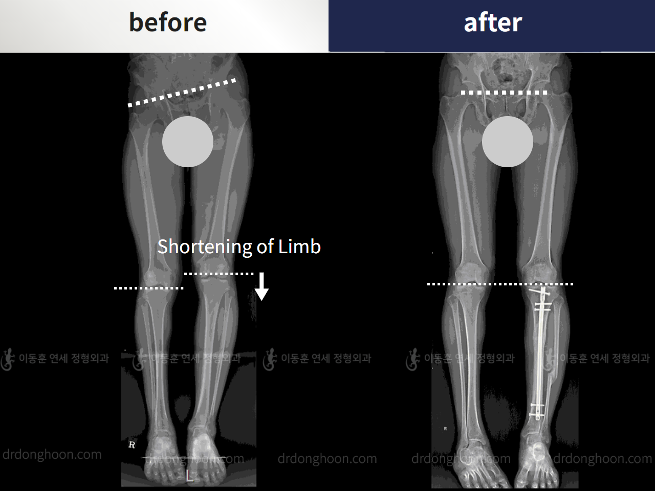 Before and after shortening of limb, case 4232448, image 3, Dr. Donghoon institute (DALRI)