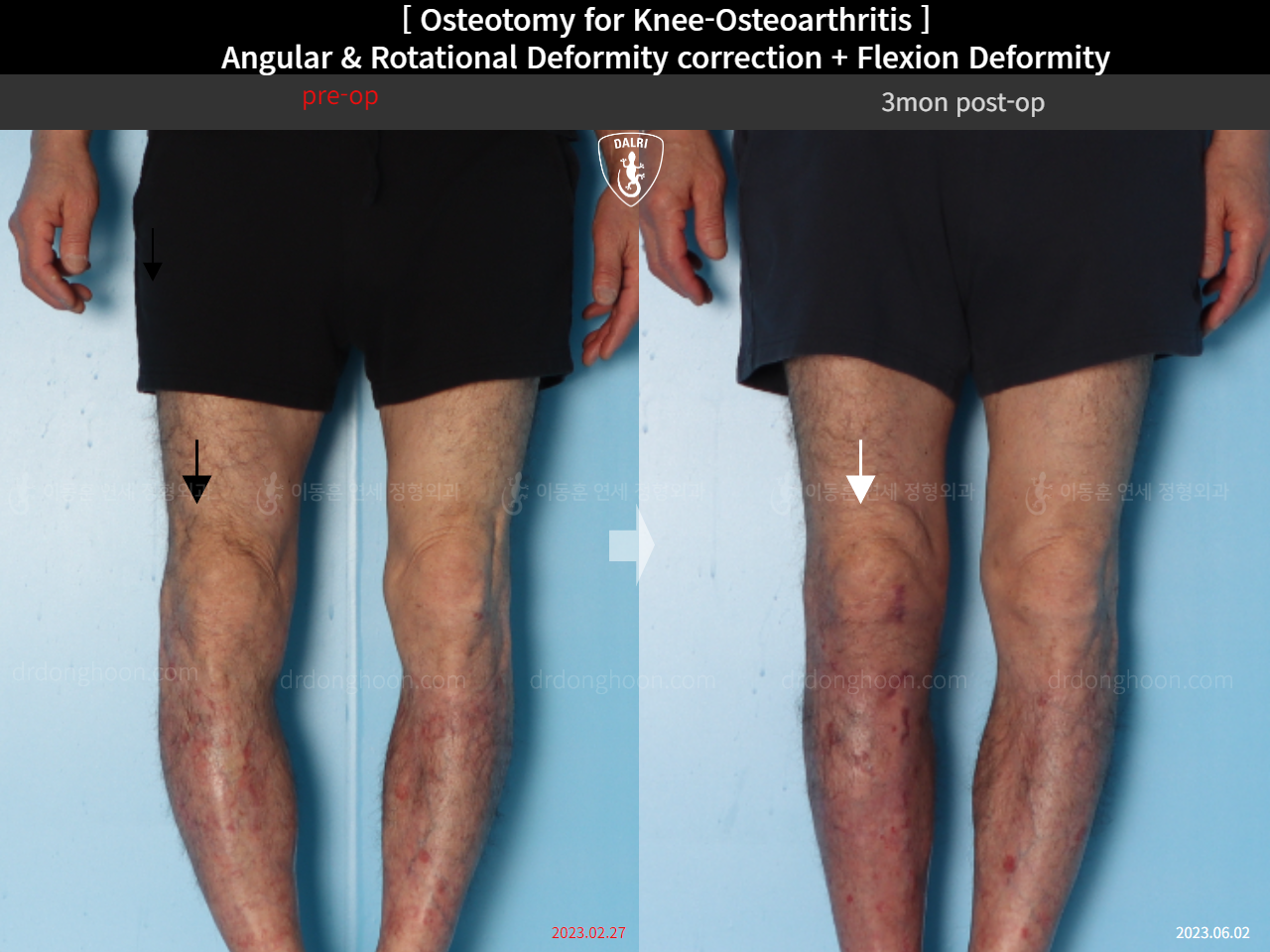 Before and after adult bowlegs, case 15362947, image 4, Dr. Donghoon institute (DALRI)
