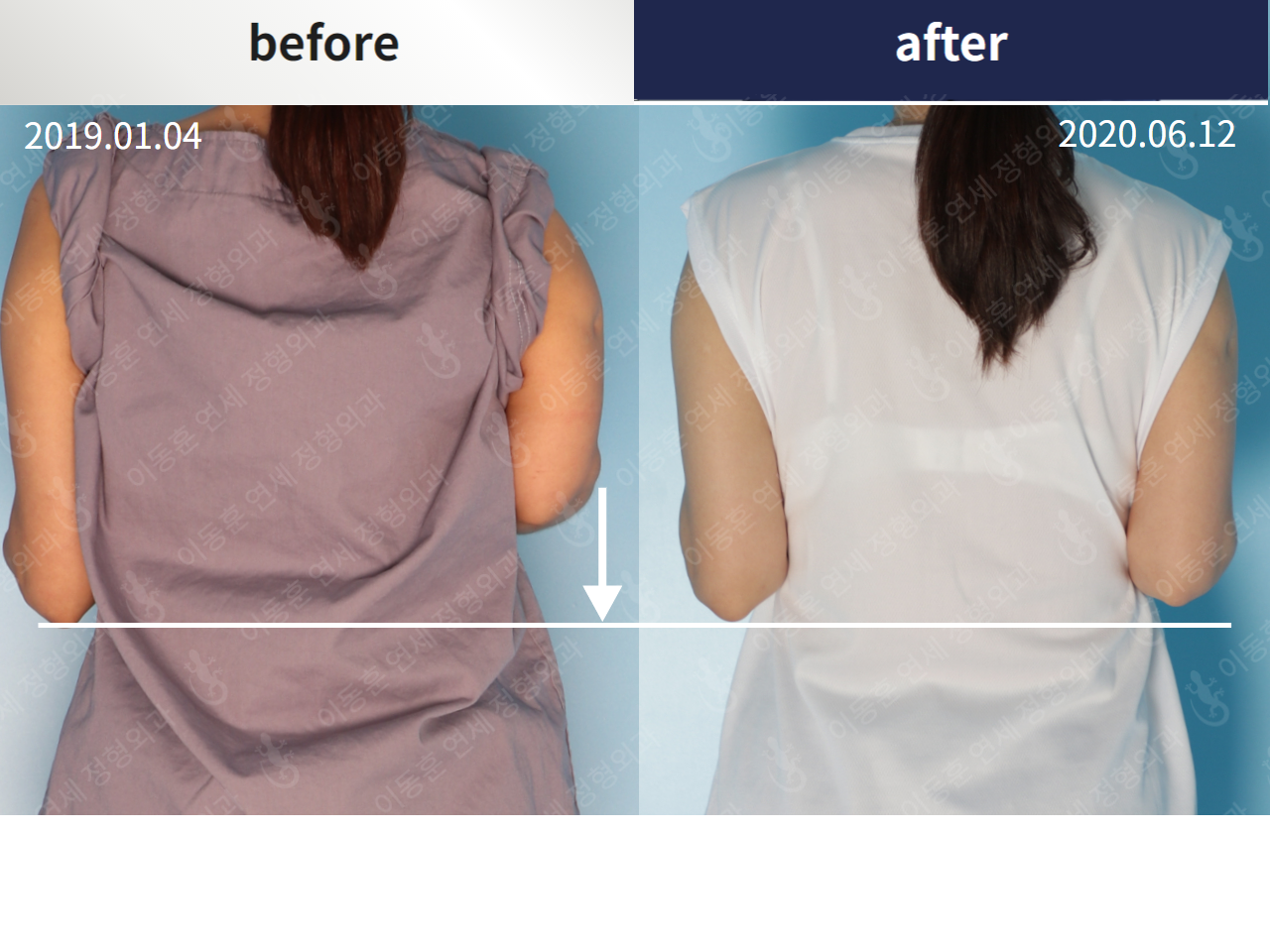 Before and after arm lengthening, case 4249436, image 2, Dr. Donghoon institute (DALRI)