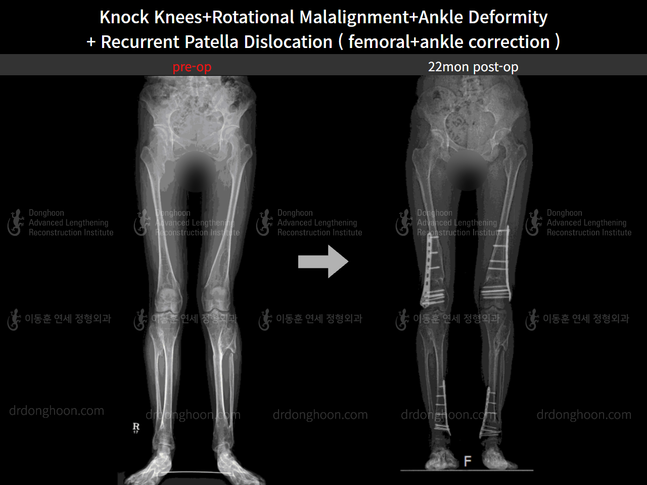 Before and after complex deformity, case 8652558, image 5, Dr. Donghoon institute (DALRI)