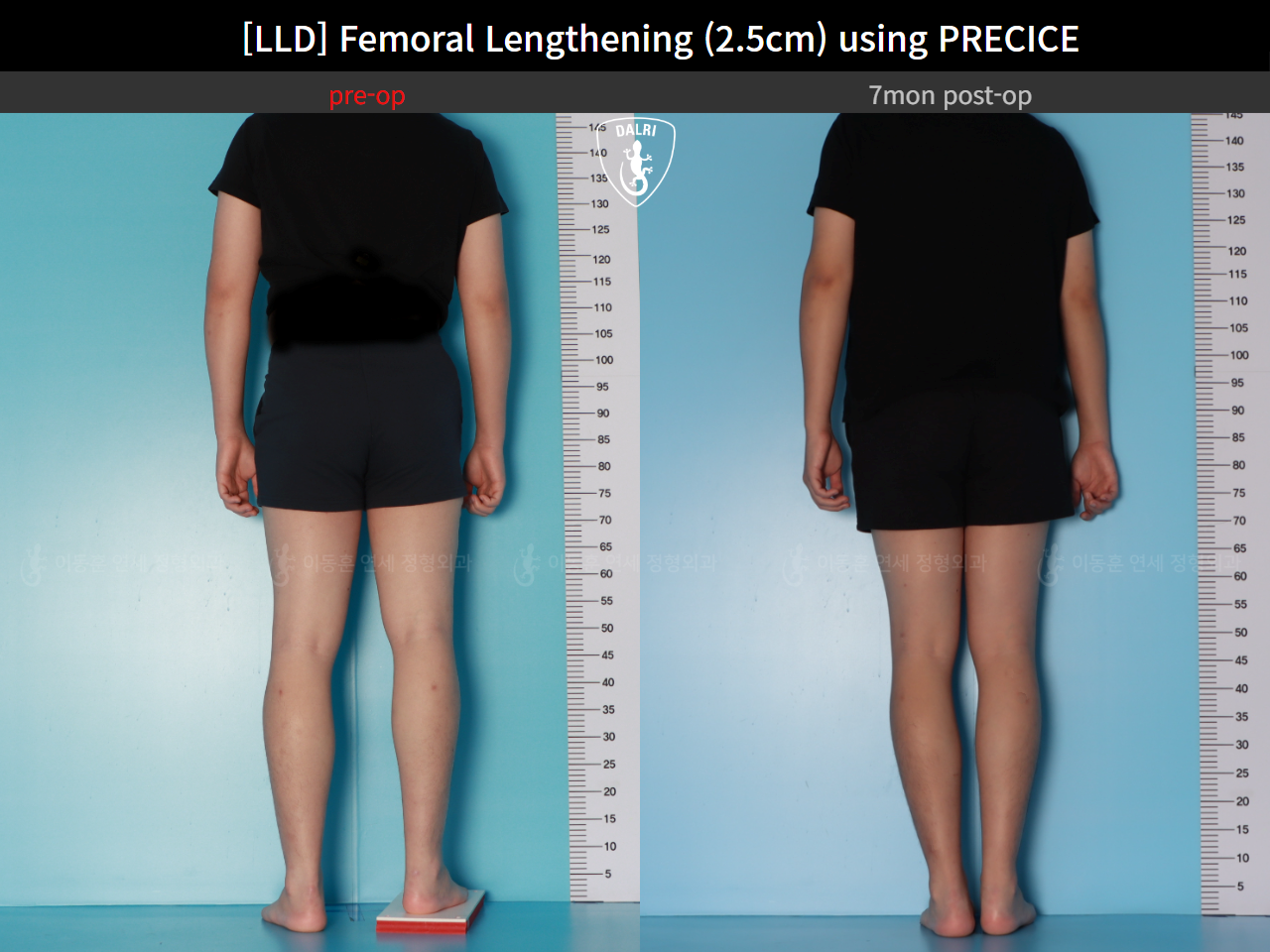 Before and after adult lld, case 127180202, image 2, Dr. Donghoon institute (DALRI)