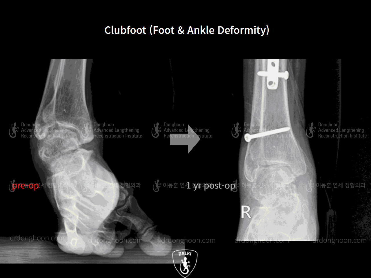 Before and after congenital clubfoot, case 9231529, image 8, Dr. Donghoon institute (DALRI)