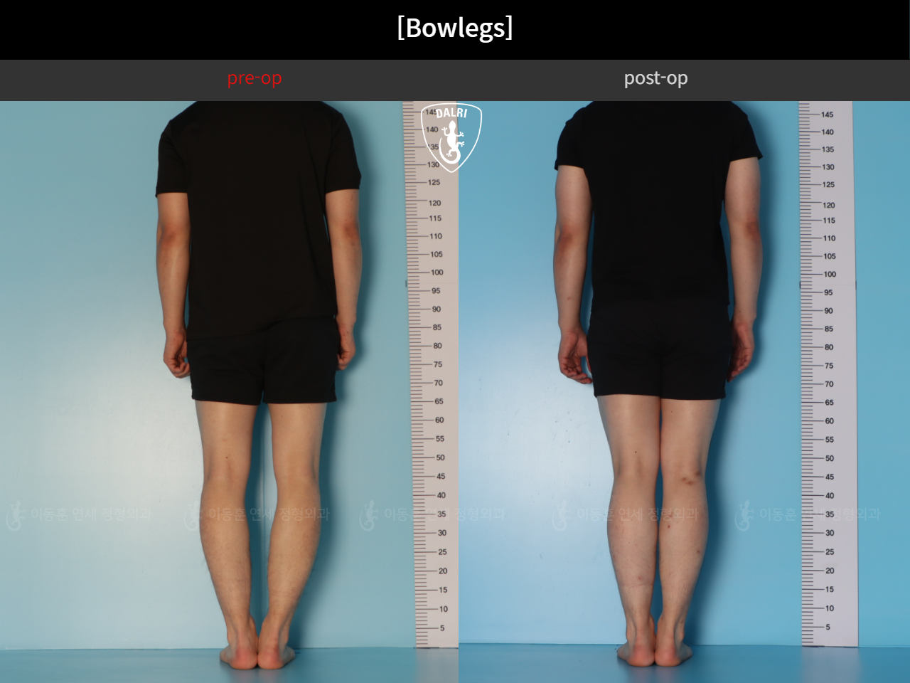 Before and after adult bowlegs, case 44111770, image 4, Dr. Donghoon institute (DALRI)