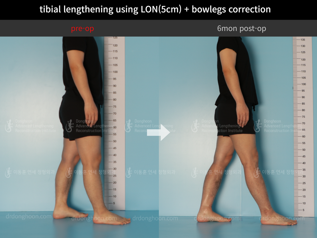 Before and after cll + deformity correction, case 11925306, image 3, Dr. Donghoon institute (DALRI)