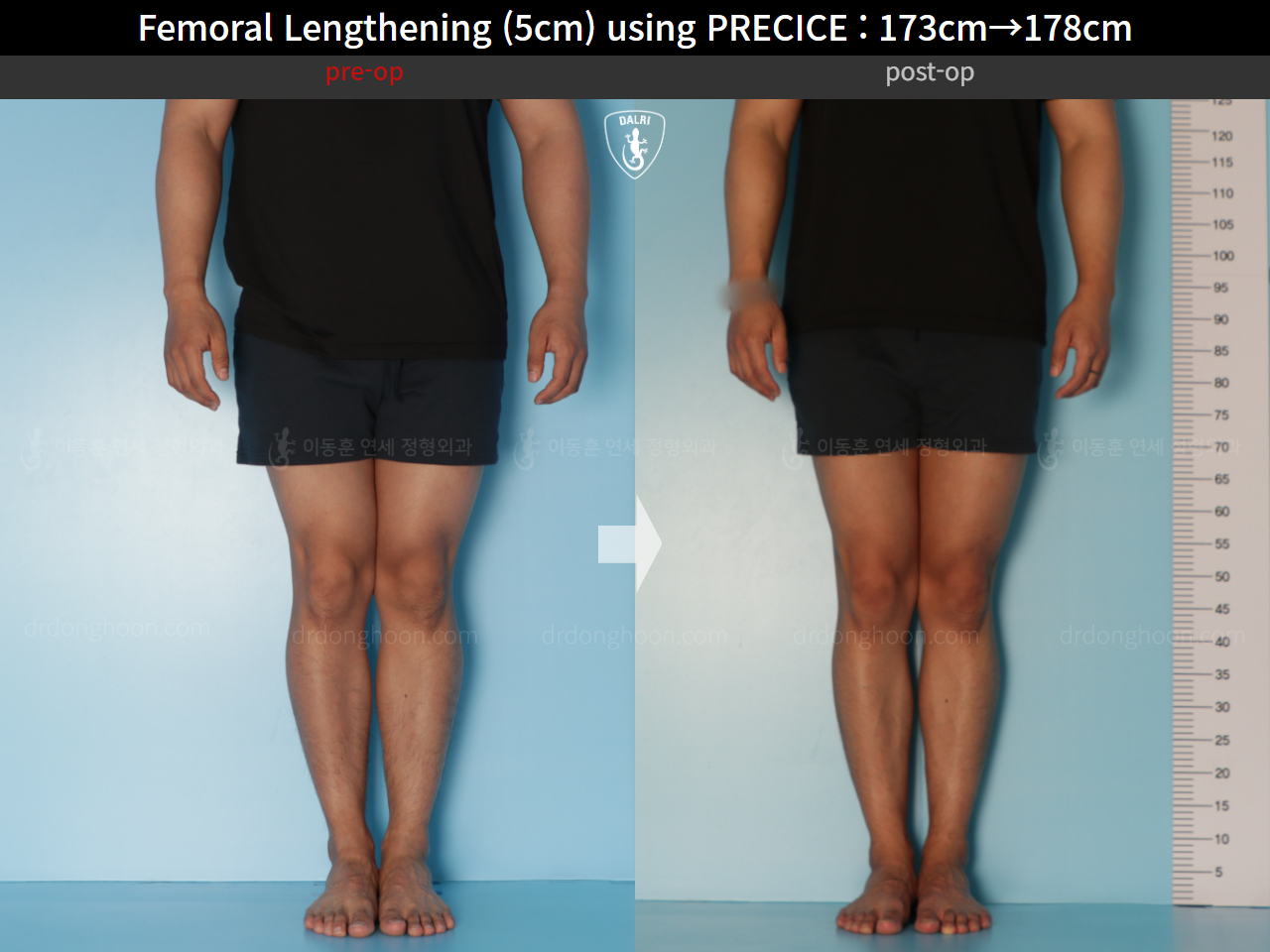 Before and after cll precice, case 21702609, image 7, Dr. Donghoon institute (DALRI)