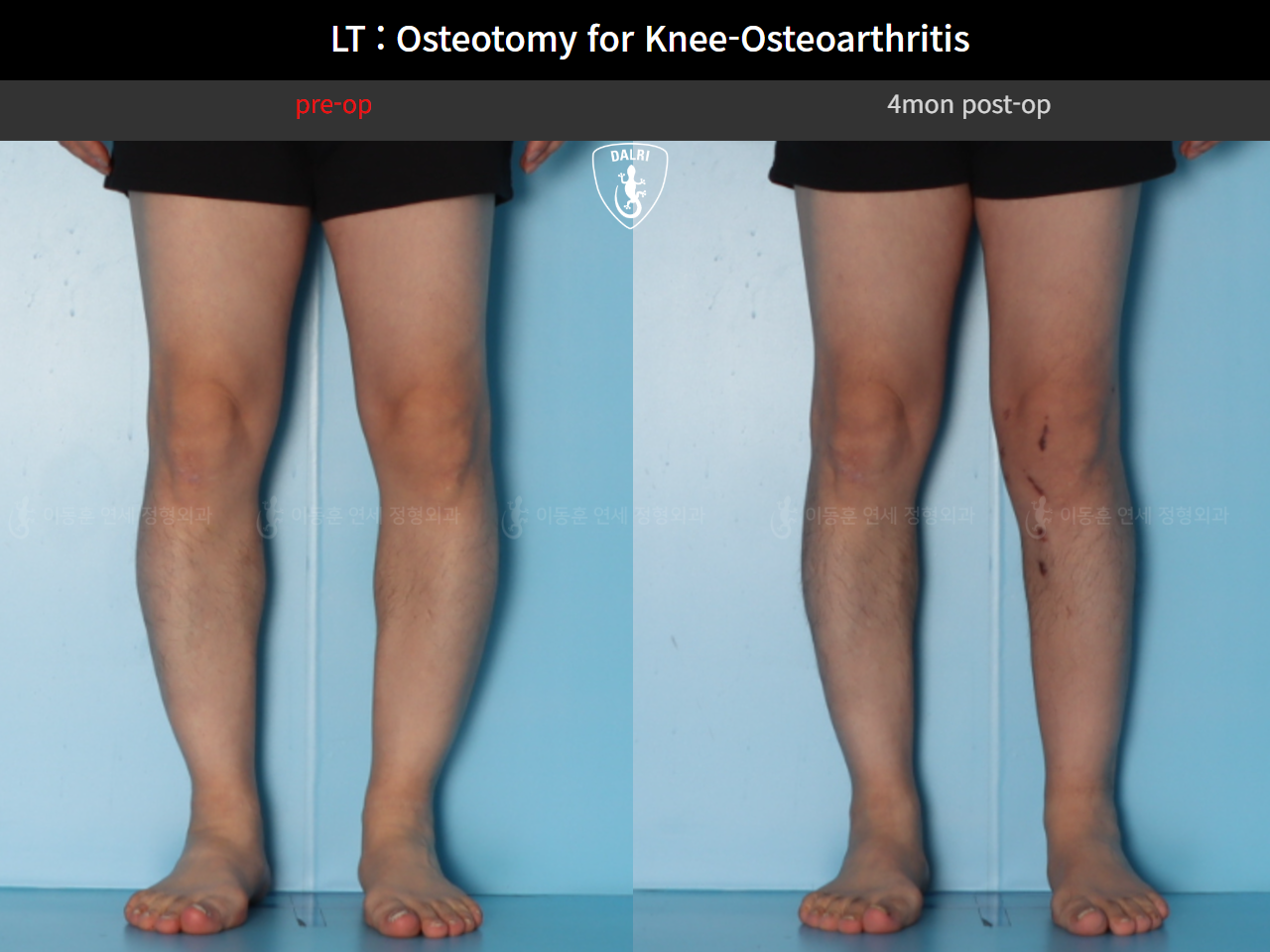 Before and after osteotomy for knee osteoarthritis, case 128374850, image 8, Dr. Donghoon institute (DALRI)