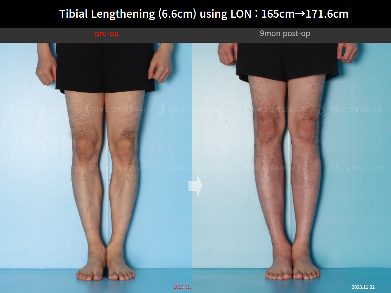 Before and after cll lon, case 16780660, image 9, Dr. Donghoon institute (DALRI)