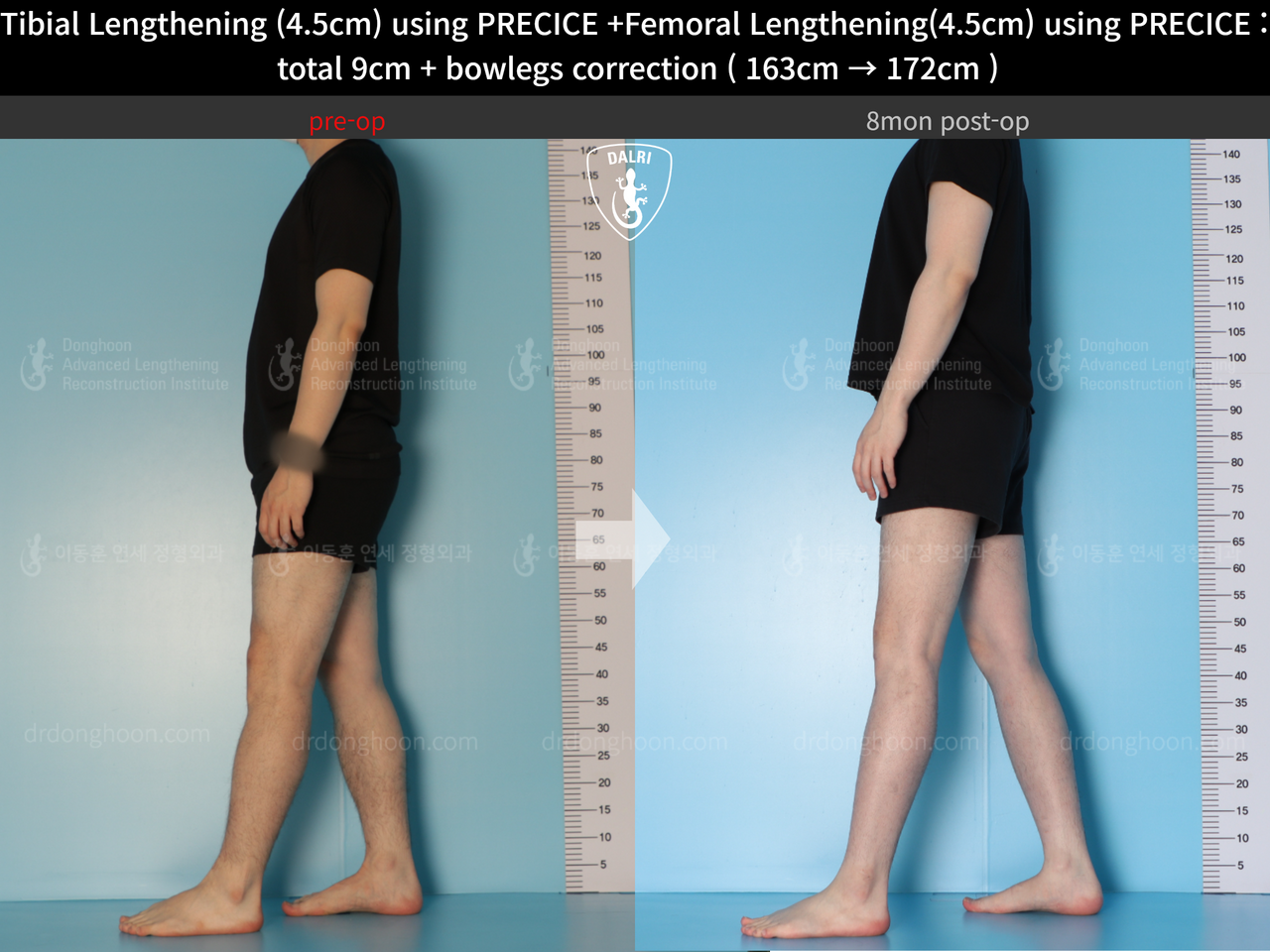 Before and after cll precice, case 13912585, image 5, Dr. Donghoon institute (DALRI)