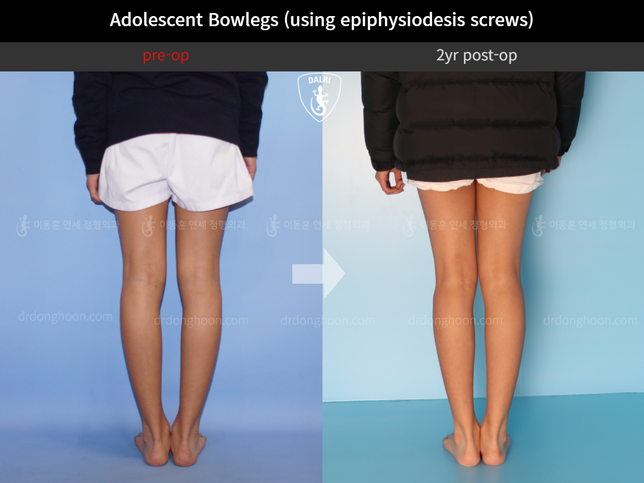 Before and after paediatric & adolescent bowlegs, case 4585777, image 4, Dr. Donghoon institute (DALRI)