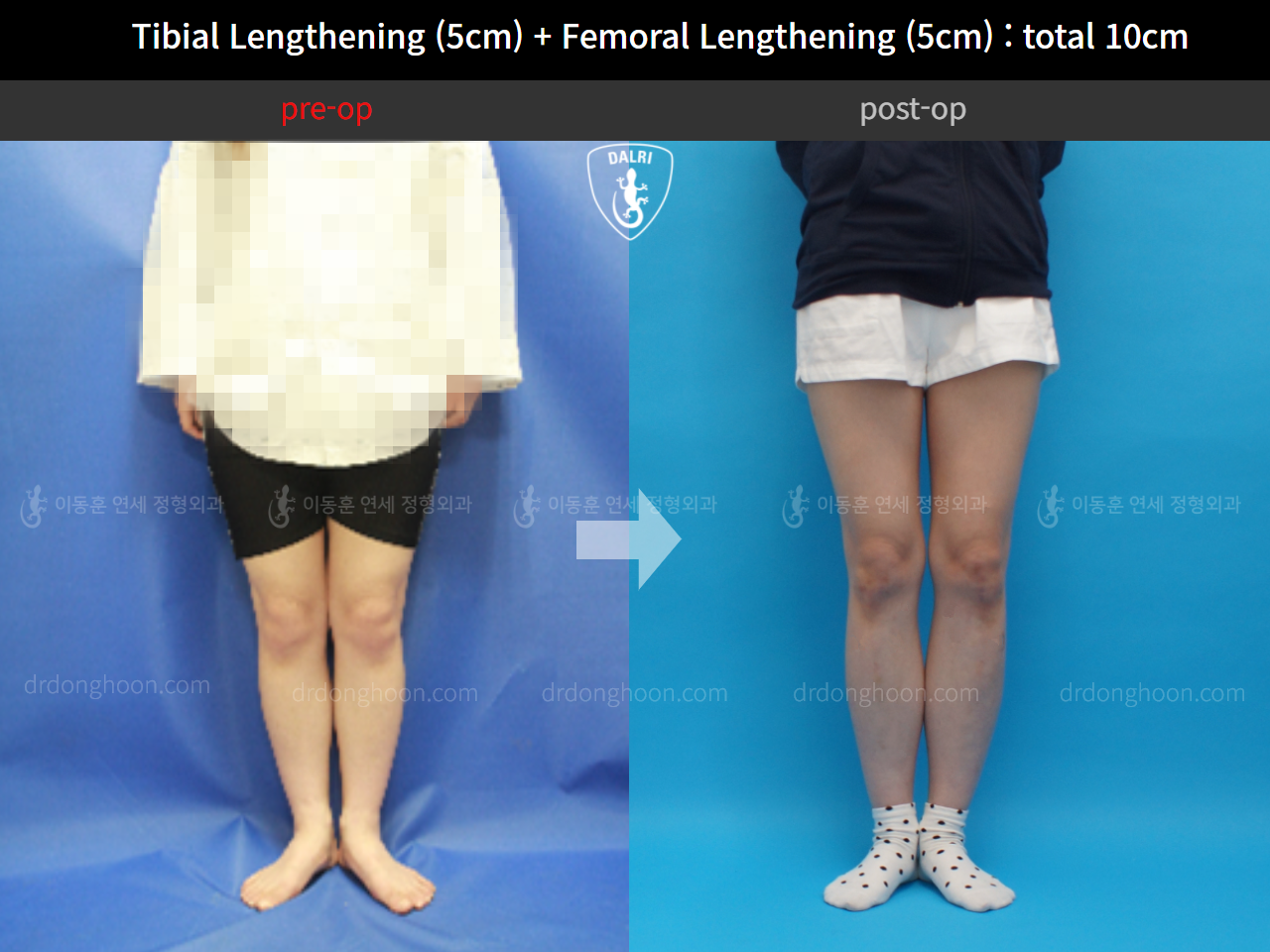 Before and after cll lon, case 11035009, image 3, Dr. Donghoon institute (DALRI)