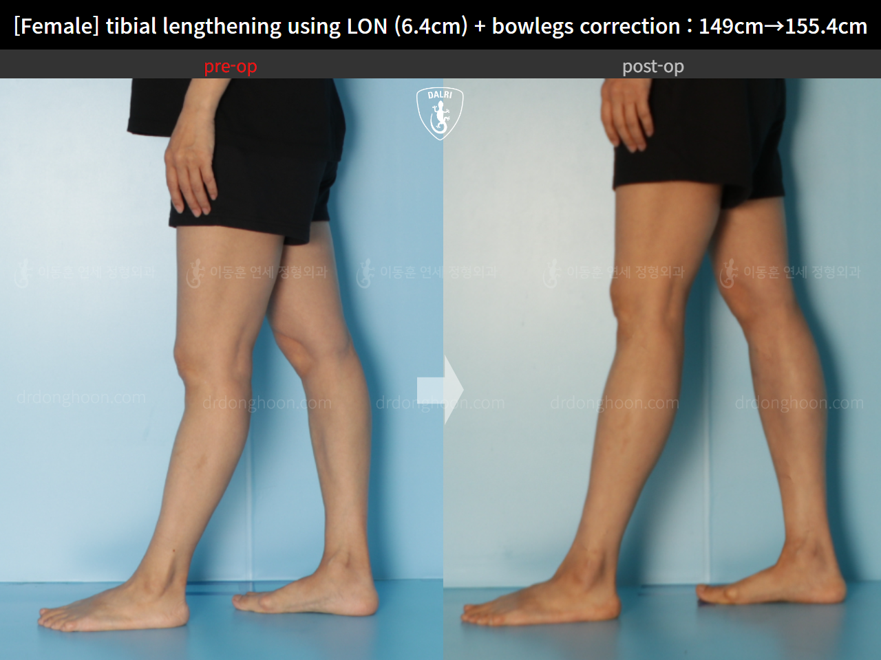 Before and after cll lon, case 15615051, image 8, Dr. Donghoon institute (DALRI)