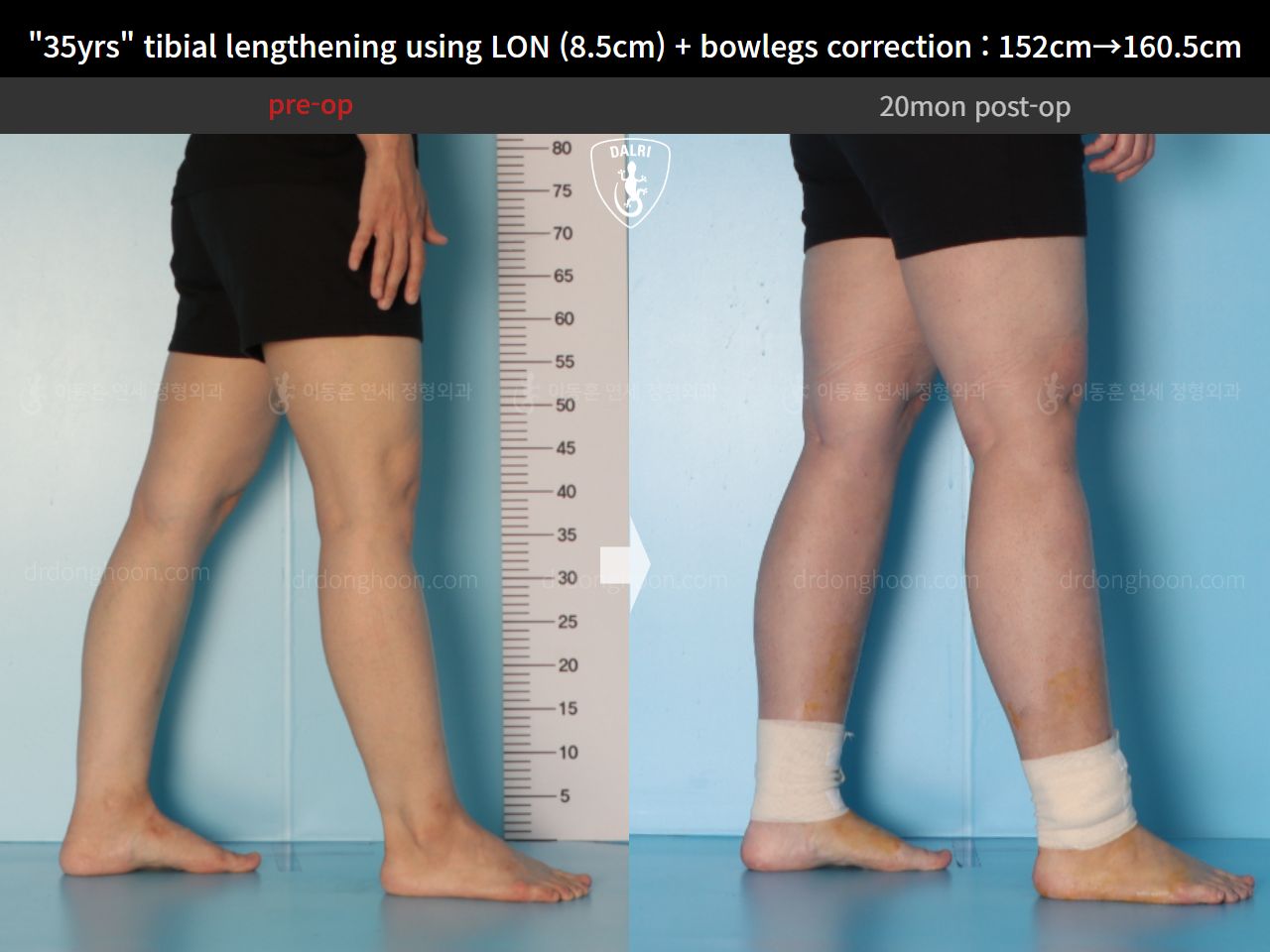 Before and after cll lon, case 15036651, image 10, Dr. Donghoon institute (DALRI)