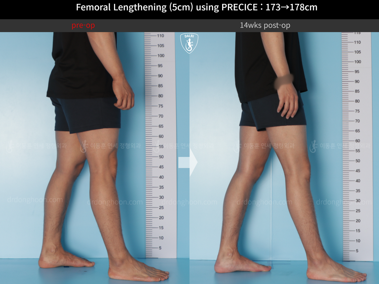 Before and after cll precice, case 14448457, image 7, Dr. Donghoon institute (DALRI)