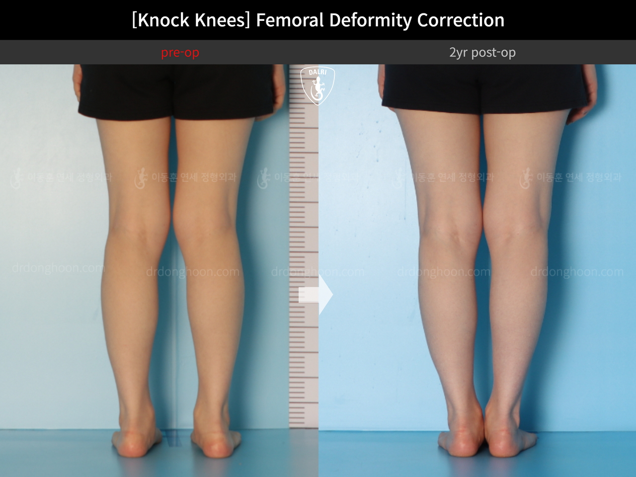 Before and after adult knock knees, case 14343877, image 4, Dr. Donghoon institute (DALRI)