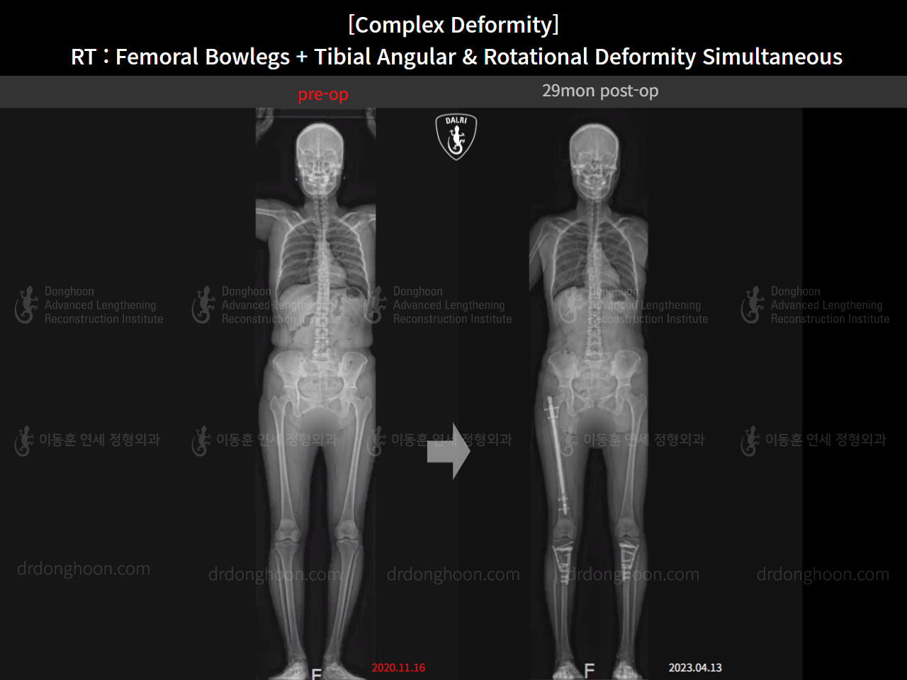 Before and after adult bowlegs, case 14771490, image 13, Dr. Donghoon institute (DALRI)