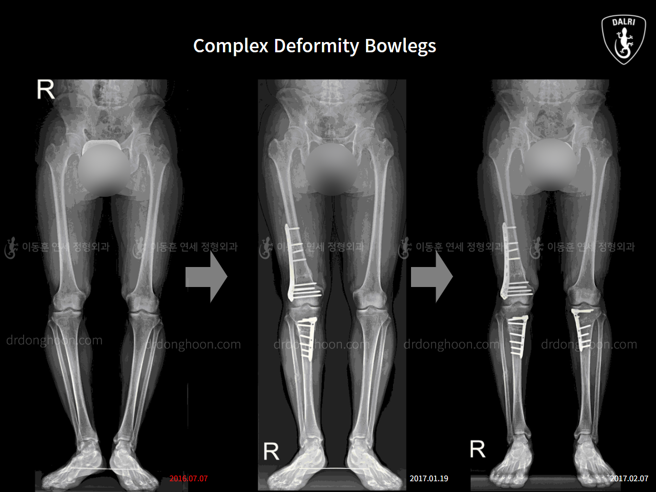 Before and after complex deformity, case 11269840, image 1, Dr. Donghoon institute (DALRI)