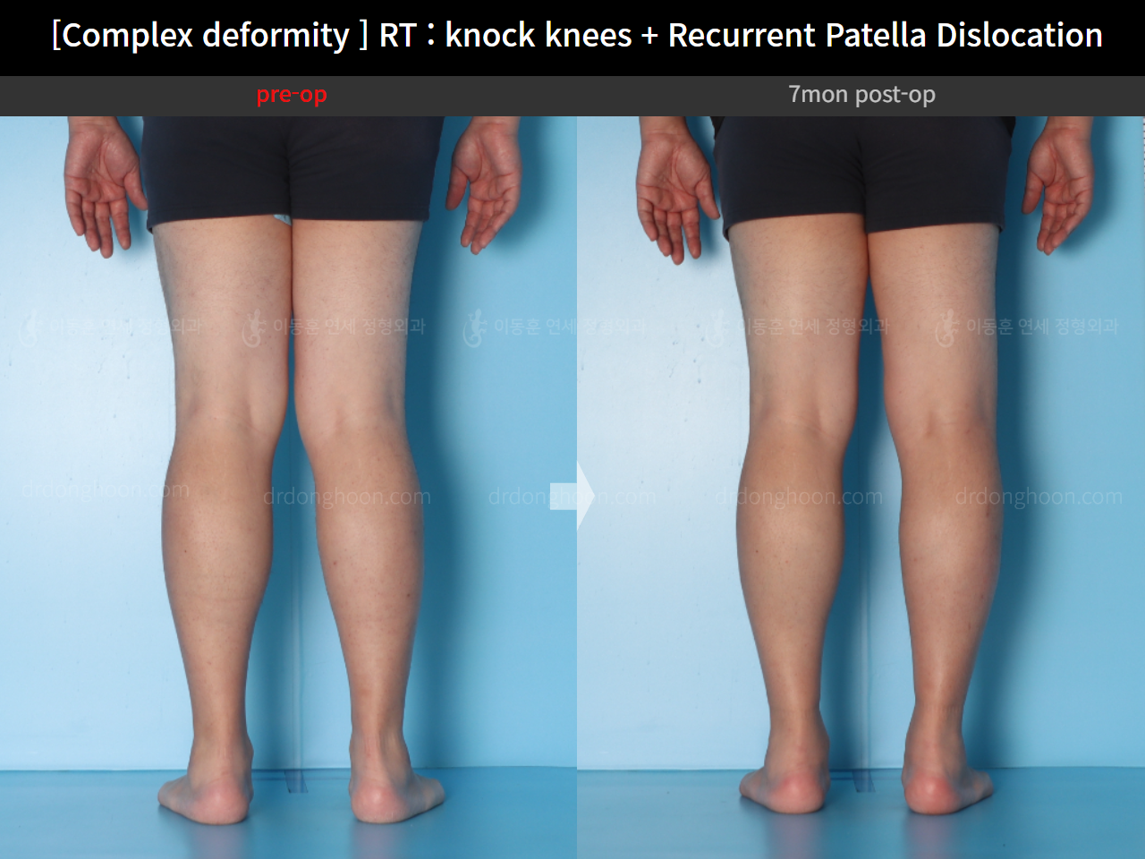 Before and after recurrent patella dislocation, case 16147031, image 8, Dr. Donghoon institute (DALRI)
