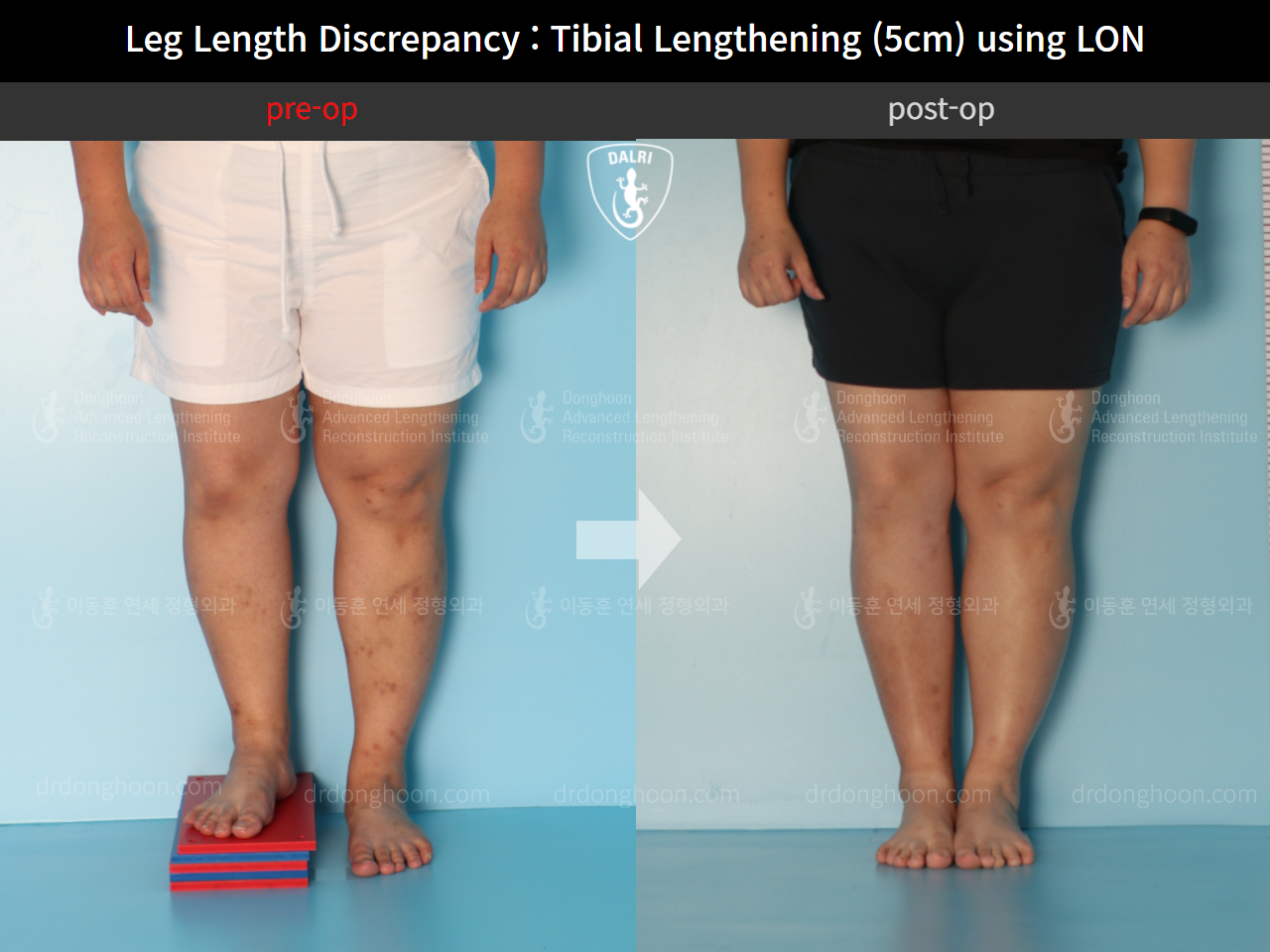 Before and after adult lld, case 9974673, image 4, Dr. Donghoon institute (DALRI)