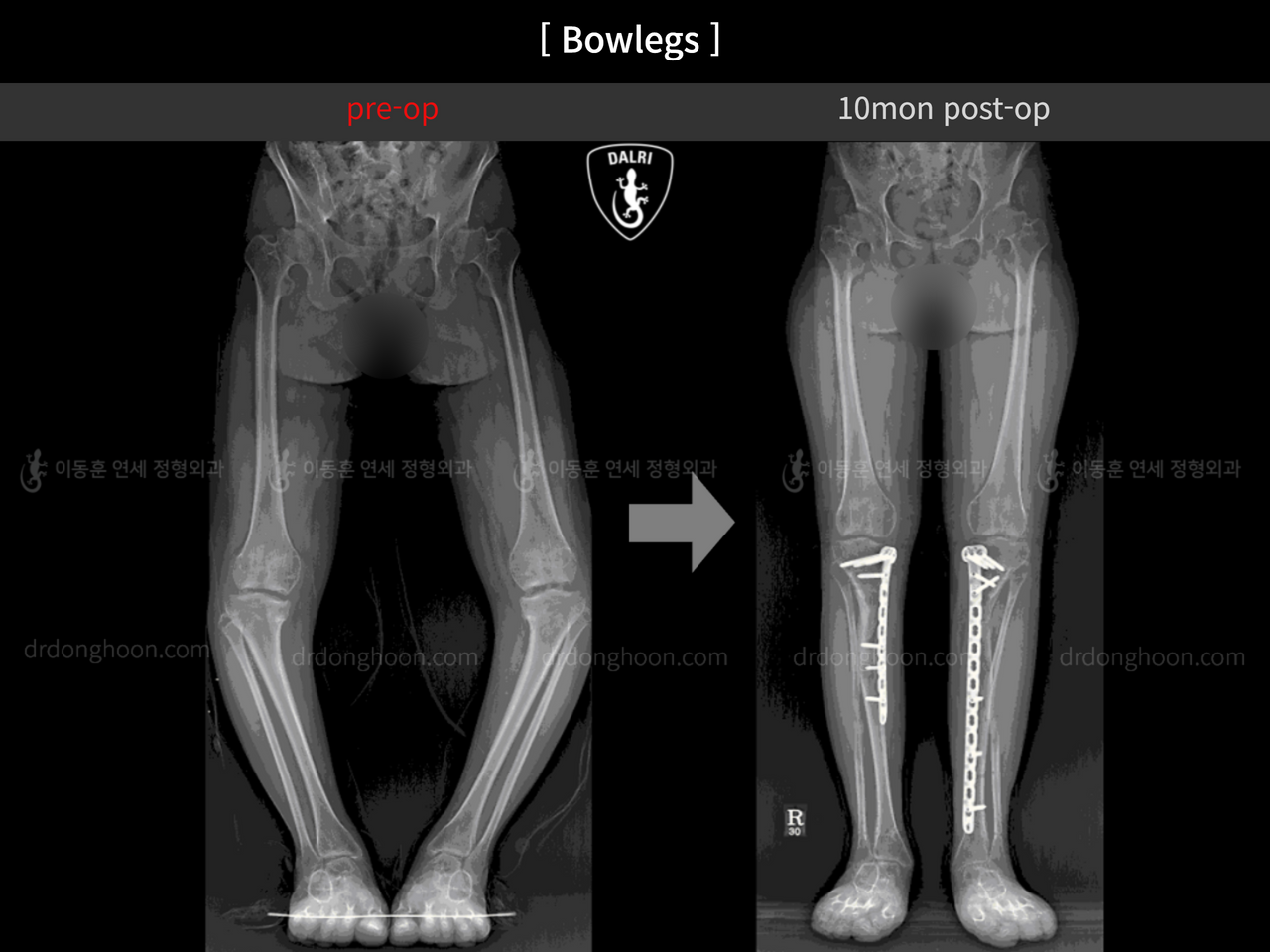 Before and after paediatric & adolescent bowlegs, case 12362822, image 2, Dr. Donghoon institute (DALRI)