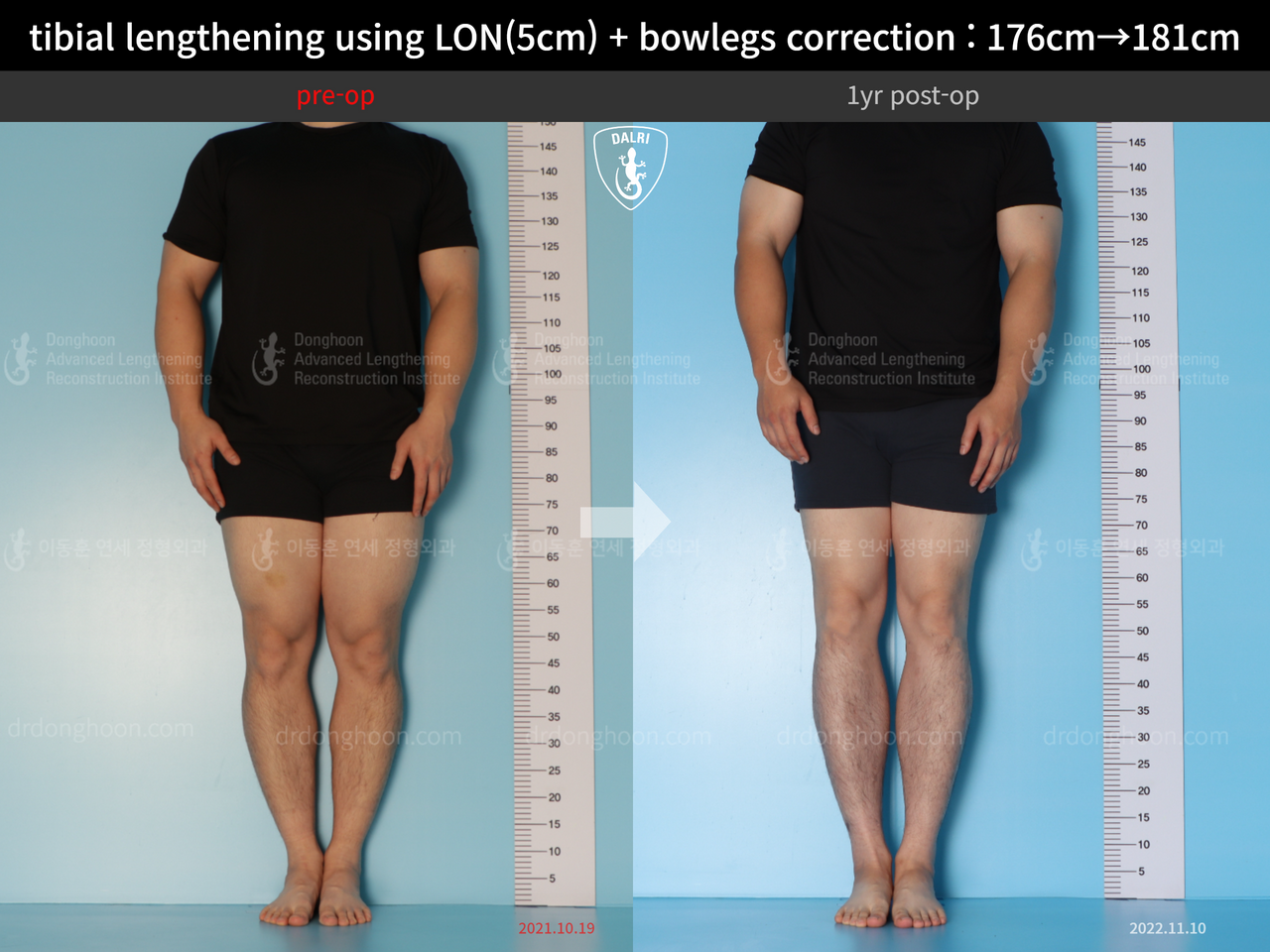 Before and after cll + deformity correction, case 13410849, image 1, Dr. Donghoon institute (DALRI)