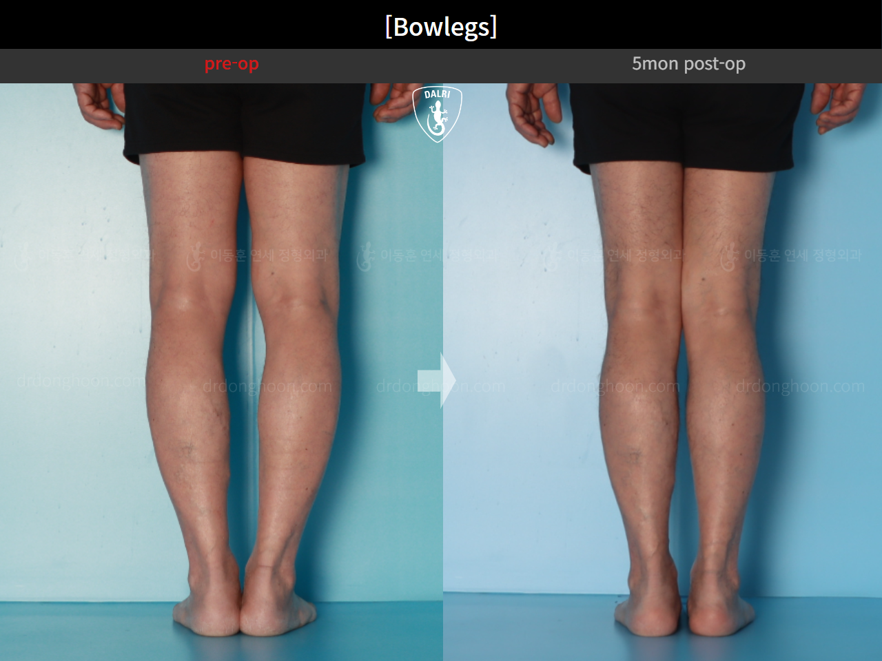 Before and after adult bowlegs, case 24988060, image 8, Dr. Donghoon institute (DALRI)