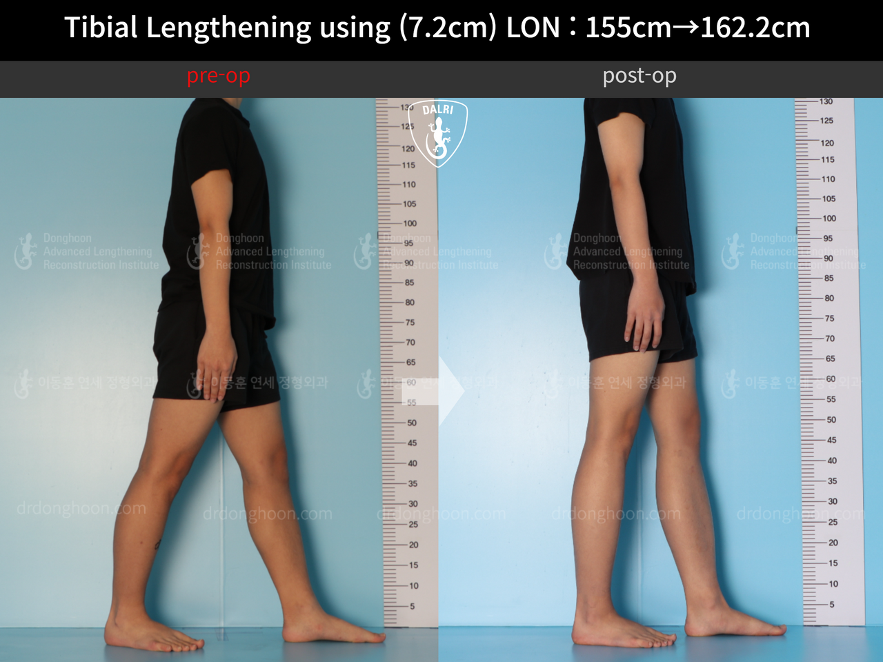 Before and after cll lon, case 13635674, image 6, Dr. Donghoon institute (DALRI)