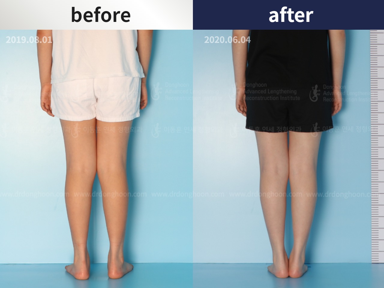 Before and after paediatric & adolescent knock knees, case 4640508, image 2, Dr. Donghoon institute (DALRI)