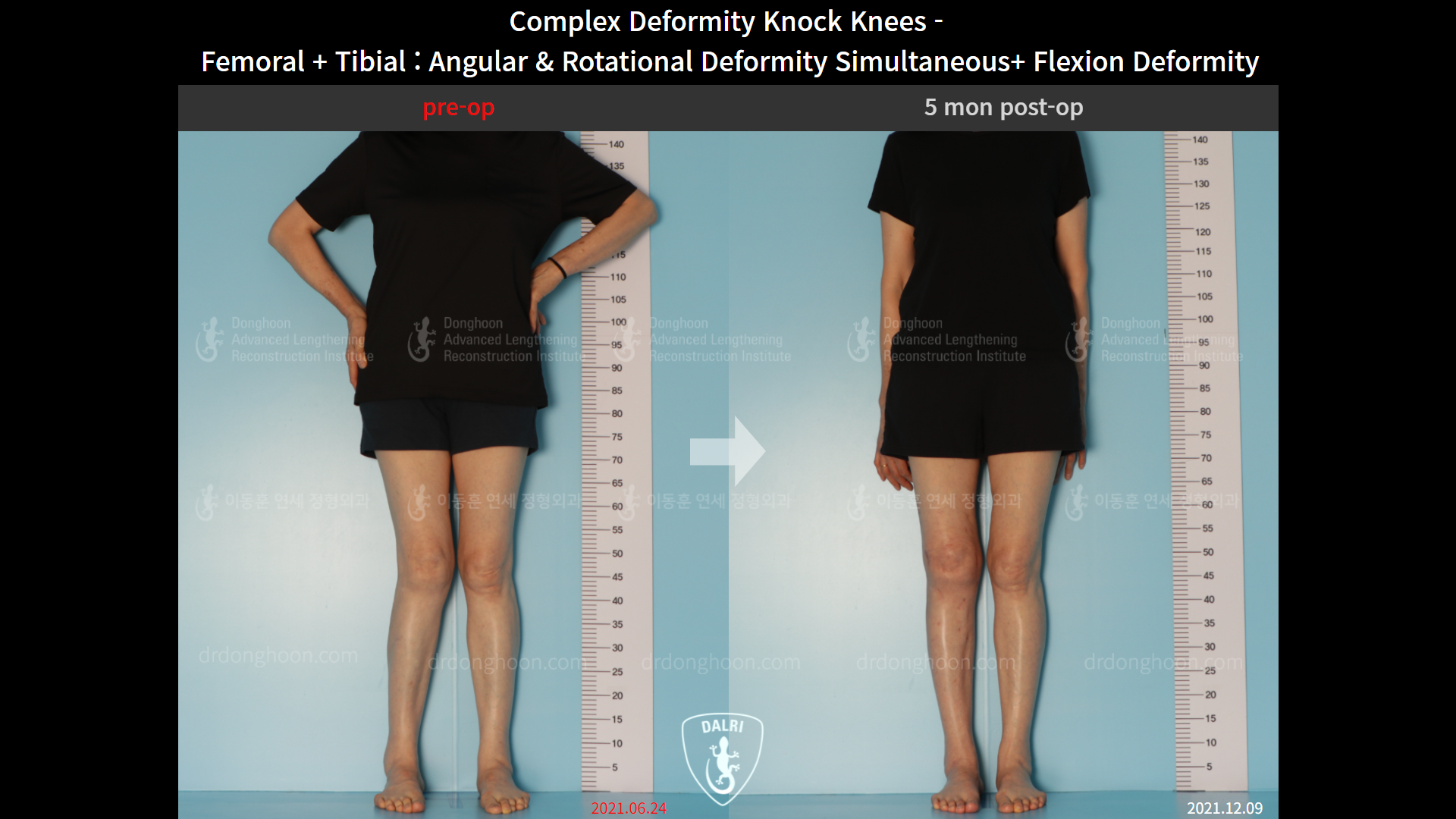 Before and after complex deformity, case 9153815, image 4, Dr. Donghoon institute (DALRI)