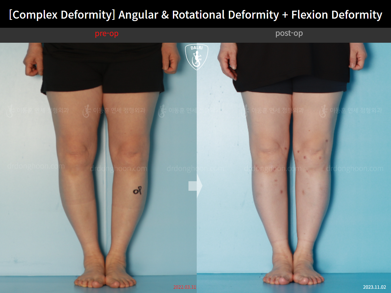 Before and after osteotomy for knee osteoarthritis, case 16781349, image 7, Dr. Donghoon institute (DALRI)
