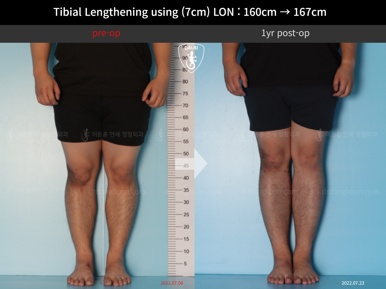 Before and after cll lon, case 12395704, image 5, Dr. Donghoon institute (DALRI)