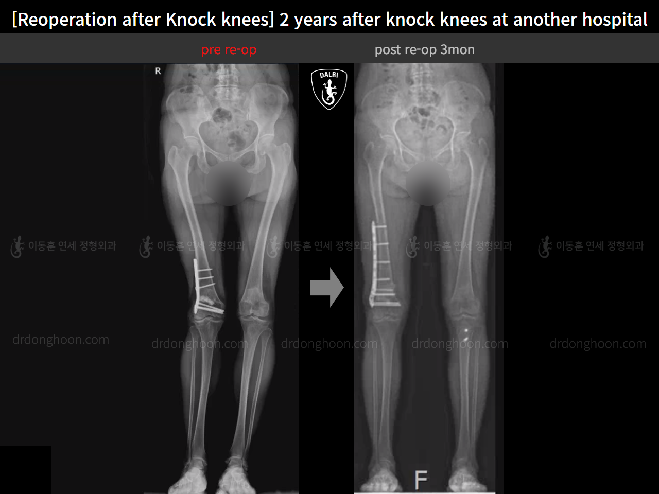 Before and after reoperation after deformity correction, case 15622876, image 14, Dr. Donghoon institute (DALRI)