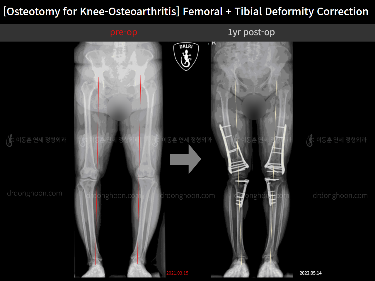 Before and after osteotomy for knee osteoarthritis, case 11512420, image 2, Dr. Donghoon institute (DALRI)