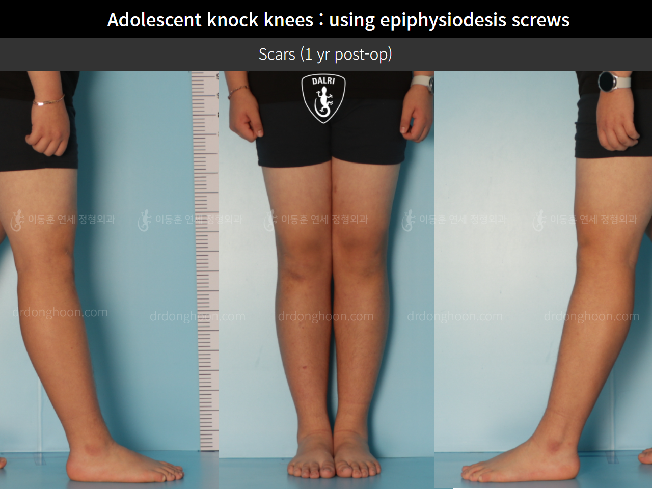 Before and after paediatric & adolescent knock knees, case 9331989, image 5, Dr. Donghoon institute (DALRI)