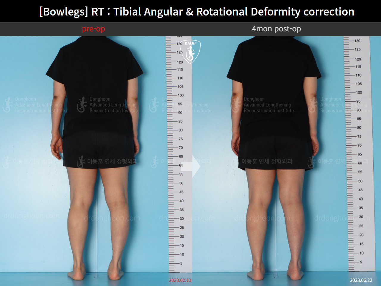 Before and after adult bowlegs, case 15741874, image 5, Dr. Donghoon institute (DALRI)