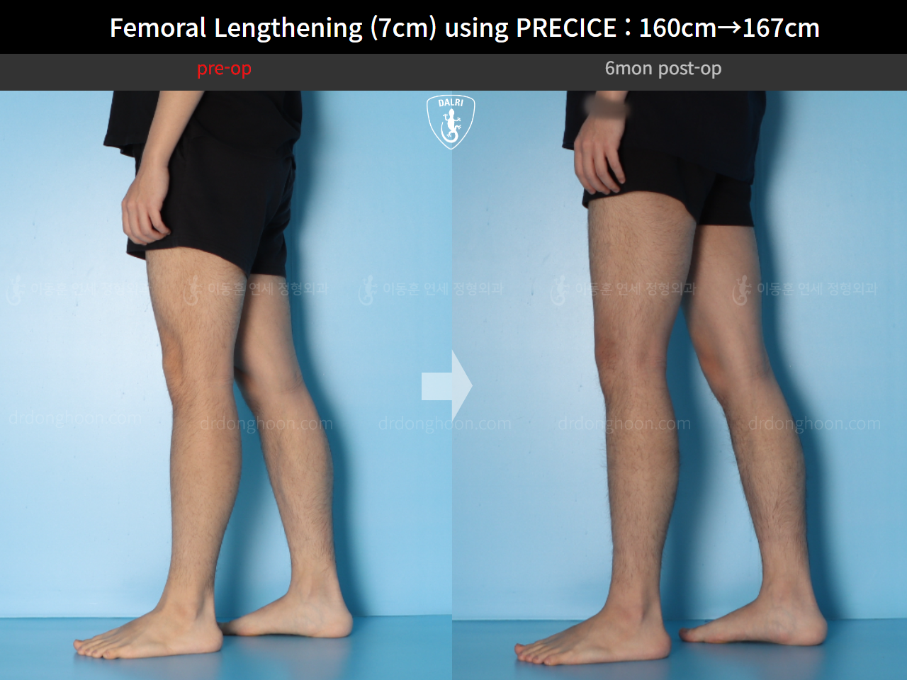 Before and after cll precice, case 15460533, image 11, Dr. Donghoon institute (DALRI)