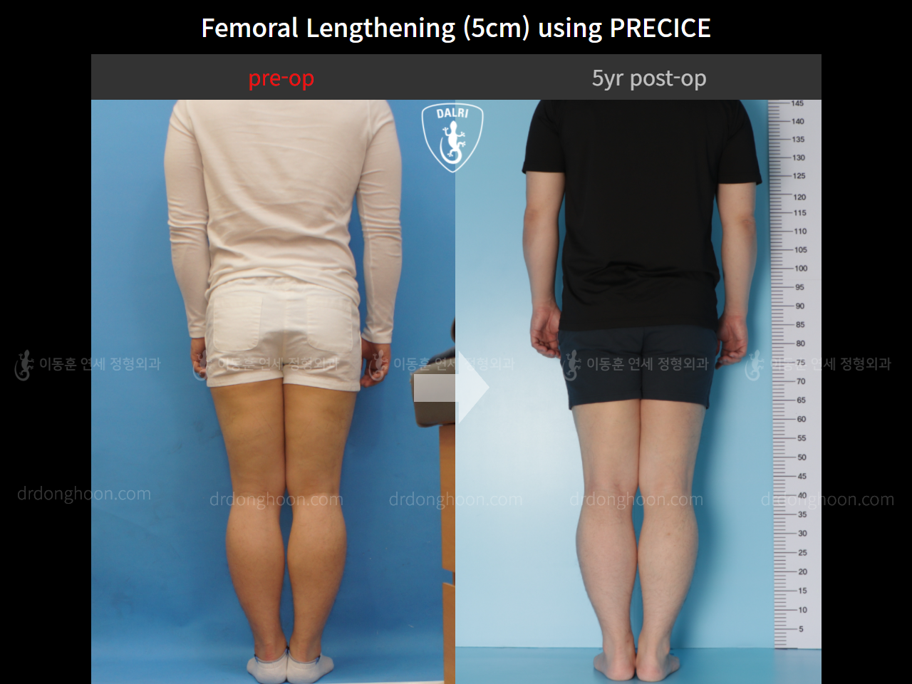 Before and after cll precice, case 4573586, image 2, Dr. Donghoon institute (DALRI)