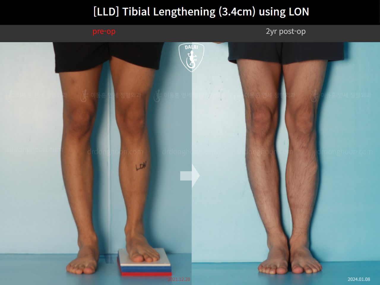 Before and after adult lld, case 17538143, image 5, Dr. Donghoon institute (DALRI)