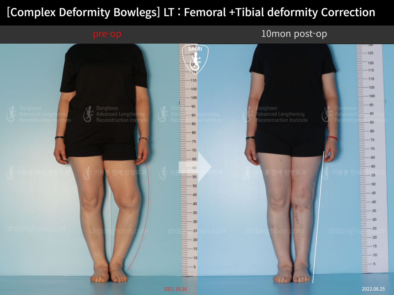 Before and after complex deformity, case 12790695, image 1, Dr. Donghoon institute (DALRI)