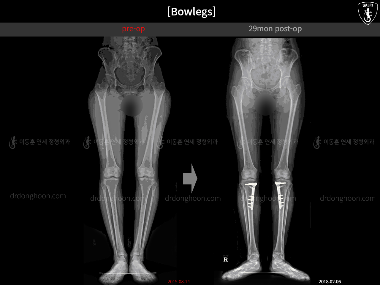 Before and after adult bowlegs, case 16102064, image 3, Dr. Donghoon institute (DALRI)