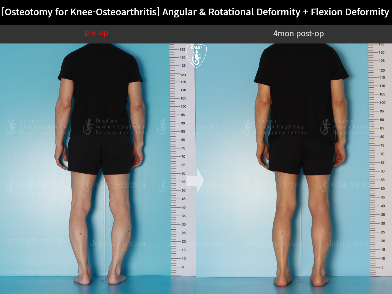 Before and after osteotomy for knee osteoarthritis, case 18162350, image 5, Dr. Donghoon institute (DALRI)