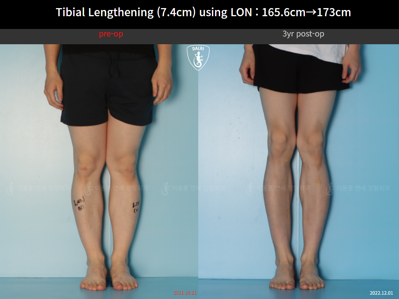Before and after cll lon, case 125561518, image 7, Dr. Donghoon institute (DALRI)
