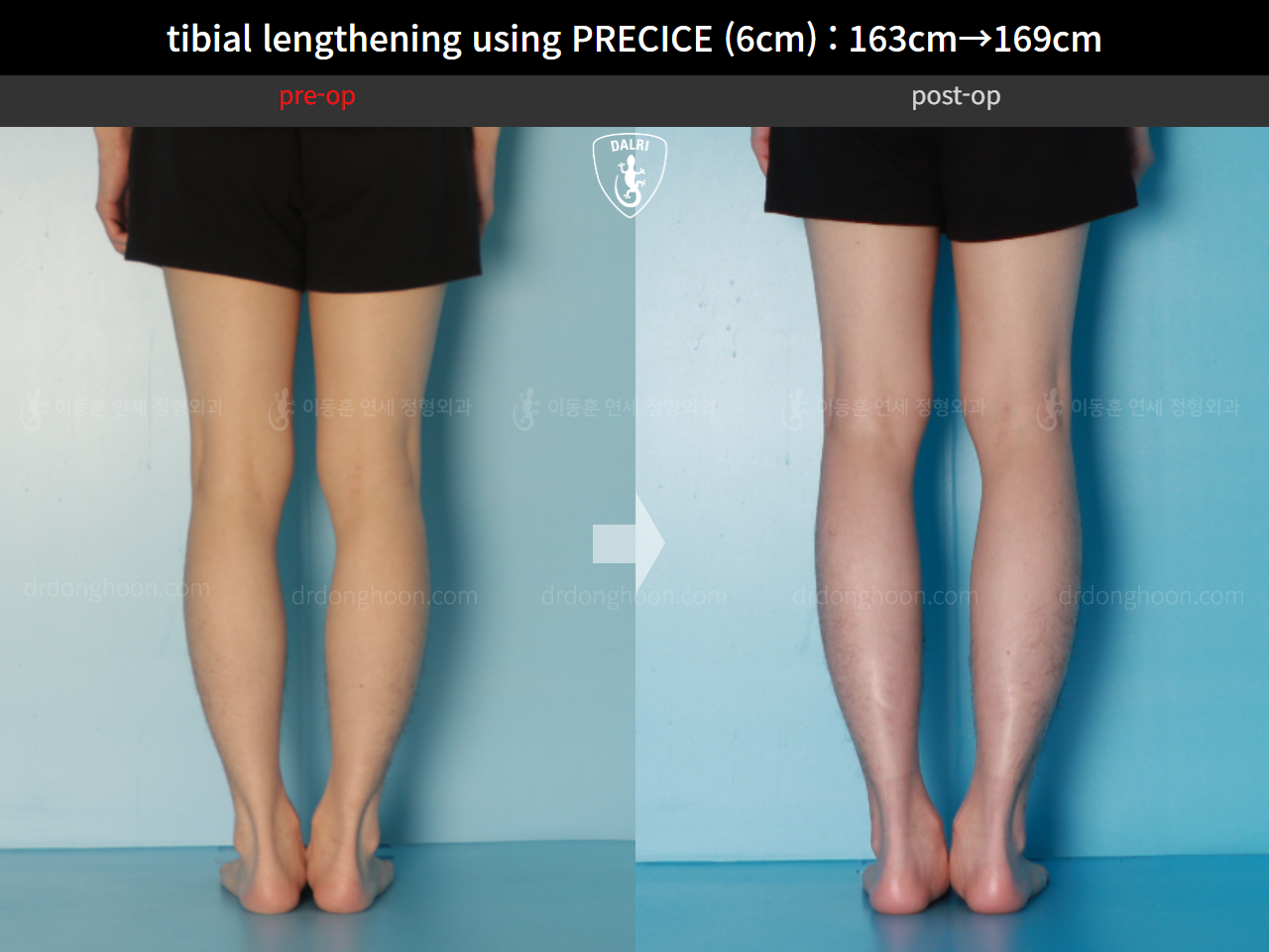 Before and after cll precice, case 16061529, image 8, Dr. Donghoon institute (DALRI)