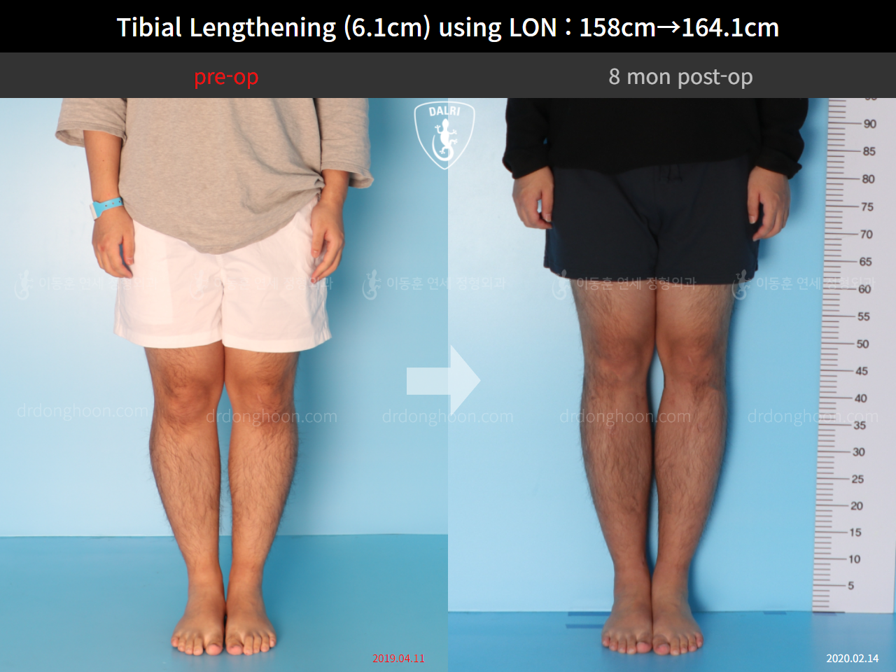 Before and after cll lon, case 4577743, image 5, Dr. Donghoon institute (DALRI)