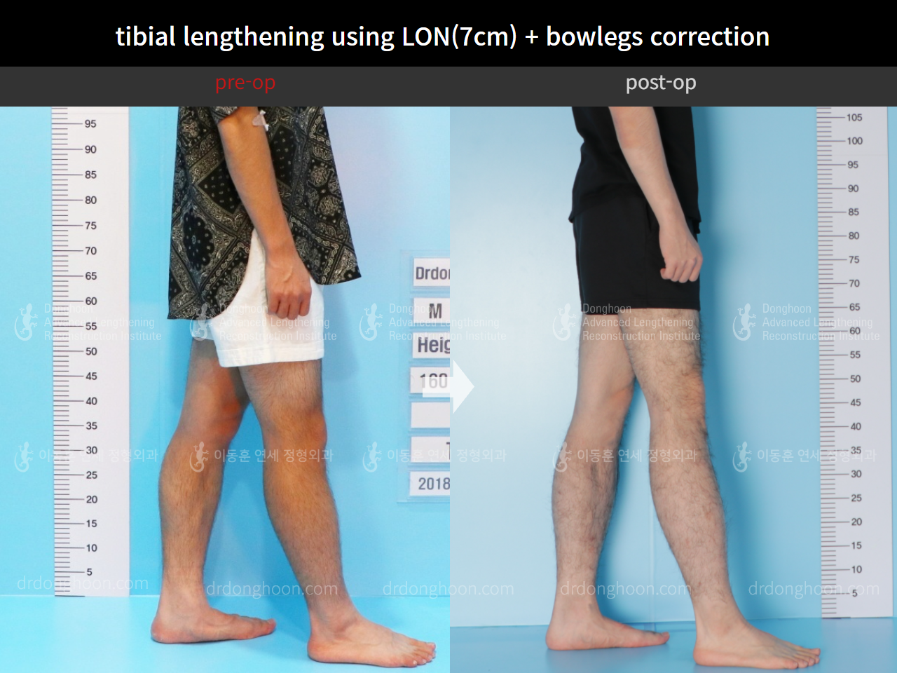 Before and after cll + deformity correction, case 4585644, image 7, Dr. Donghoon institute (DALRI)
